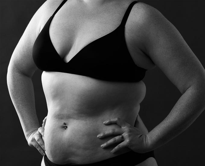 Breast Reduction Newcastle